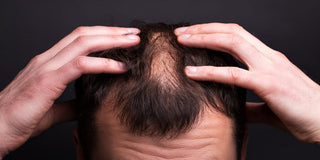 Man going bald, suffering from hair loss